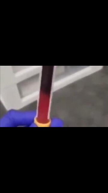 Vaccinated blood is garbage. Check this out.💉🩸🩸🩸