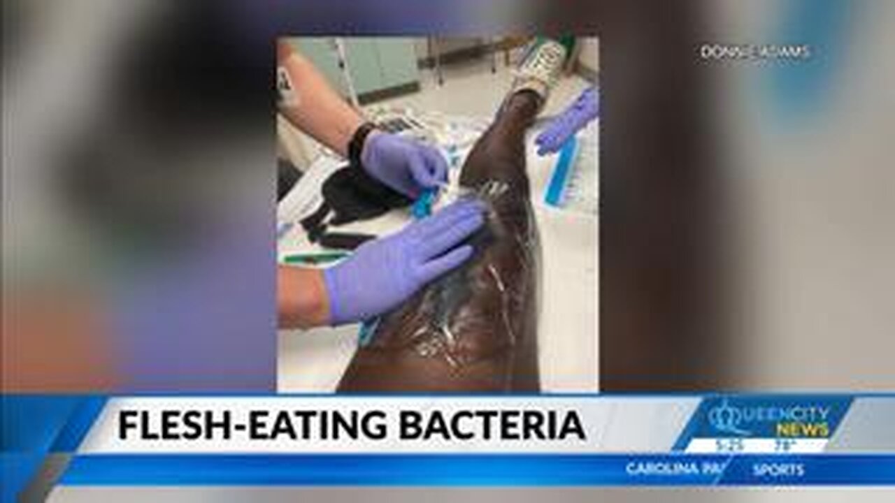 FL man gets flesh-eating bacteria after family member bites him