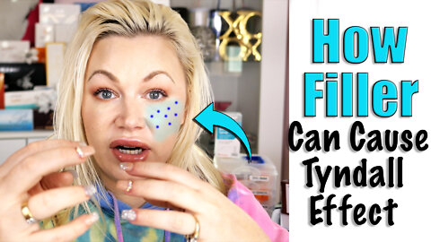 How Filler Can Cause Tyndall Effect - What YOU need to know | Code Jessica10 saves you Money