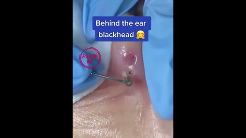 Behind the Ear Blackhead