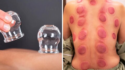 Cupping Therapy: An Ancient Technique With Many Health Benefits (Hijama Therapy)