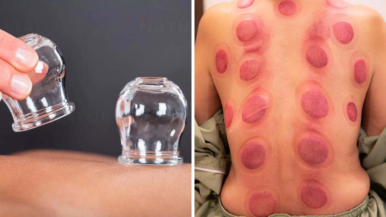Cupping Therapy: An Ancient Technique With Many Health Benefits (Hijama Therapy)