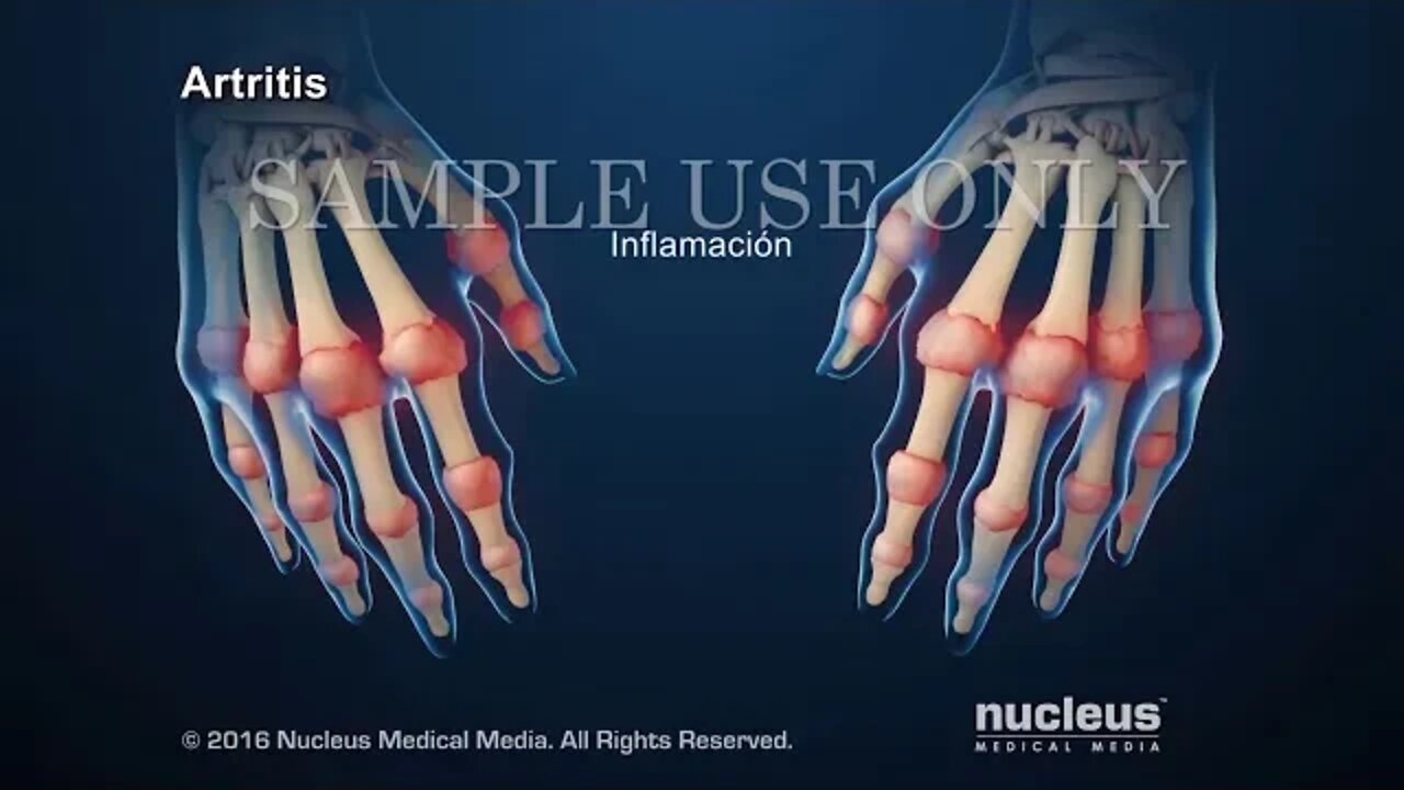 Artritis reumatoide