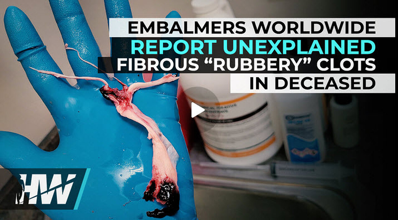 EMBALMERS WORLDWIDE REPORT UNEXPLAINED FIBROUS “RUBBERY” CLOTS IN DECEASED