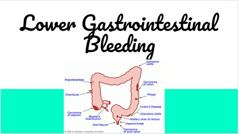 Lower Gastrointestinal Bleeding causing Bloody Stools #medicine #gastroenterology