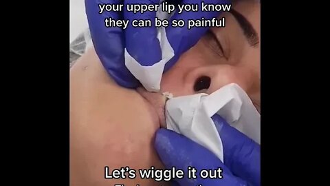 This must HURT ! Blackhead removal