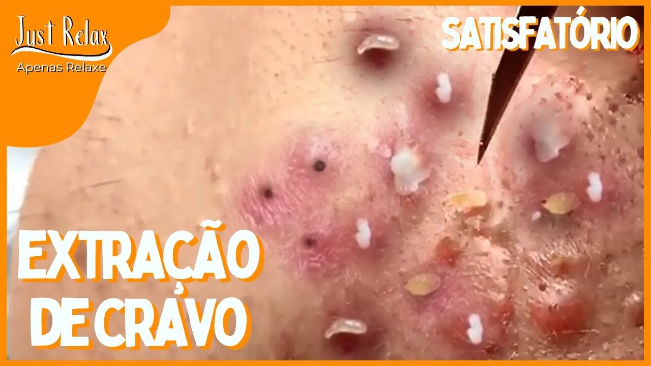 Vídeo Satisfatório Remoção de Cravos - Remove Cravos e Espinhas Asmr - Just Relax | Apenas Relaxe