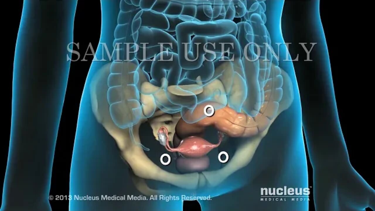 Laparoscopia pélvica diagnóstica