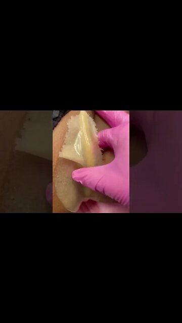 Hydrojelly Mask Removal