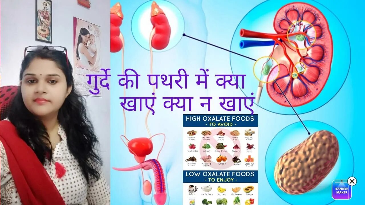 Kidney Stone Diet Plan and Prevention।।#kidneystone, #Homeopathy, #DrMinakshi