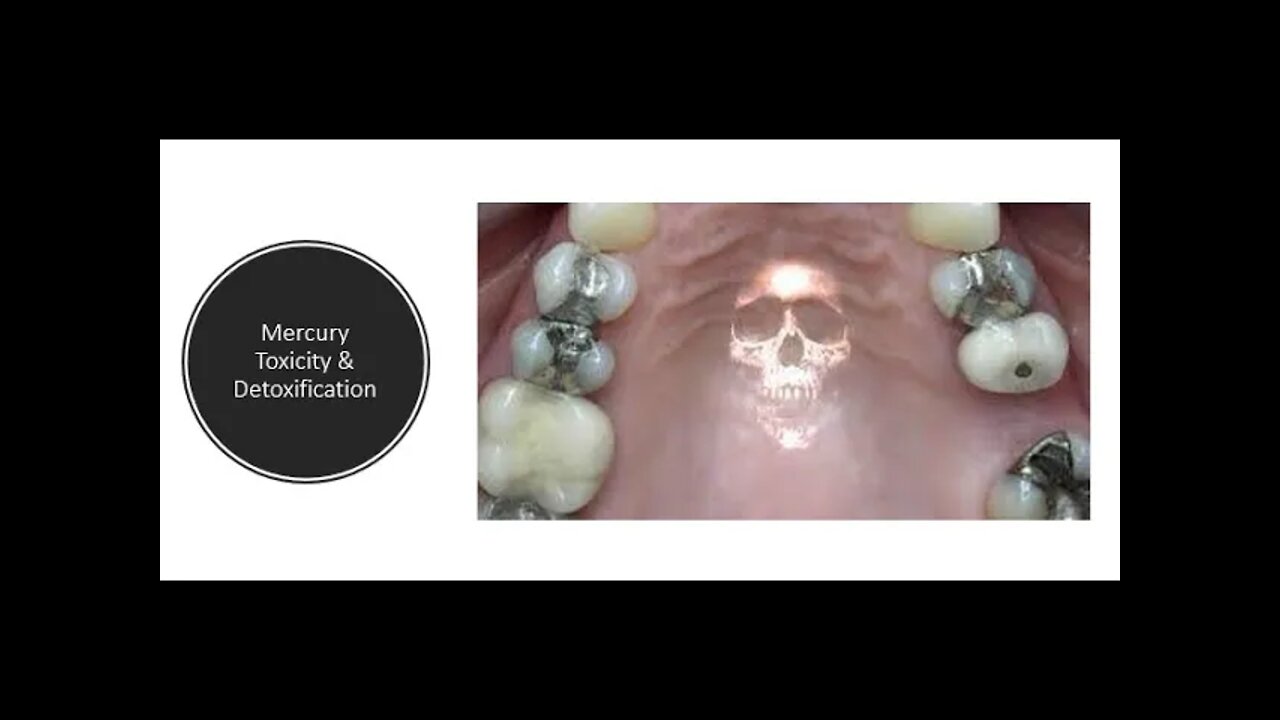 Mercury Amalgam Fillings - Detox