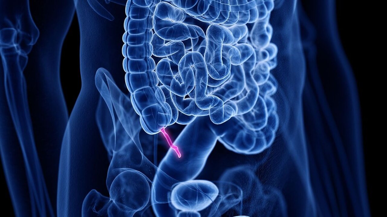 Appendicitis causes, signs, diagnosis, and treatment surgery lecture nursing and medical animation.