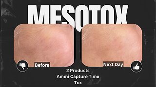 Get Rid of Smile Lines with MesoTox