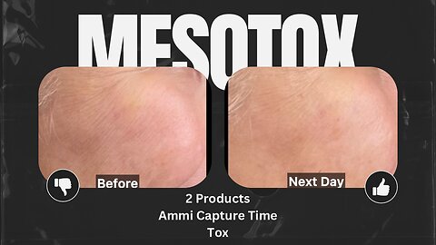 Get Rid of Smile Lines with MesoTox