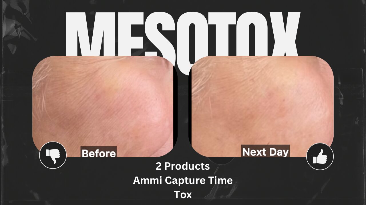 Get Rid of Smile Lines with MesoTox