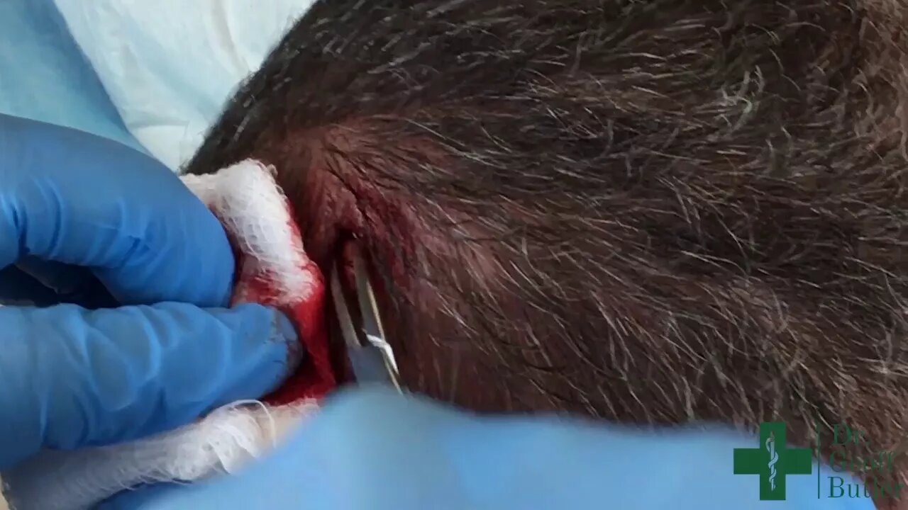 Removal of a Pilar cyst