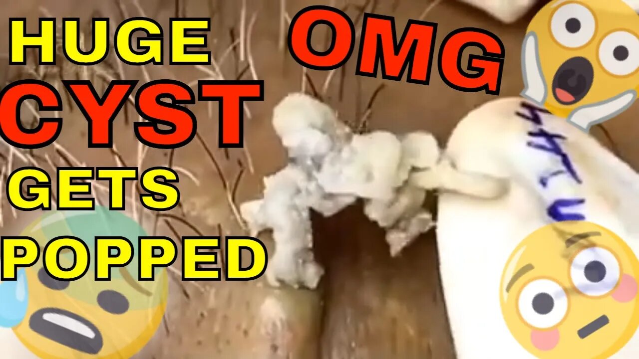 OMG huge cyst gets popped 😱 infinite long "worm" comes out! 🪱 #cyst #cystremoval #cystpopping