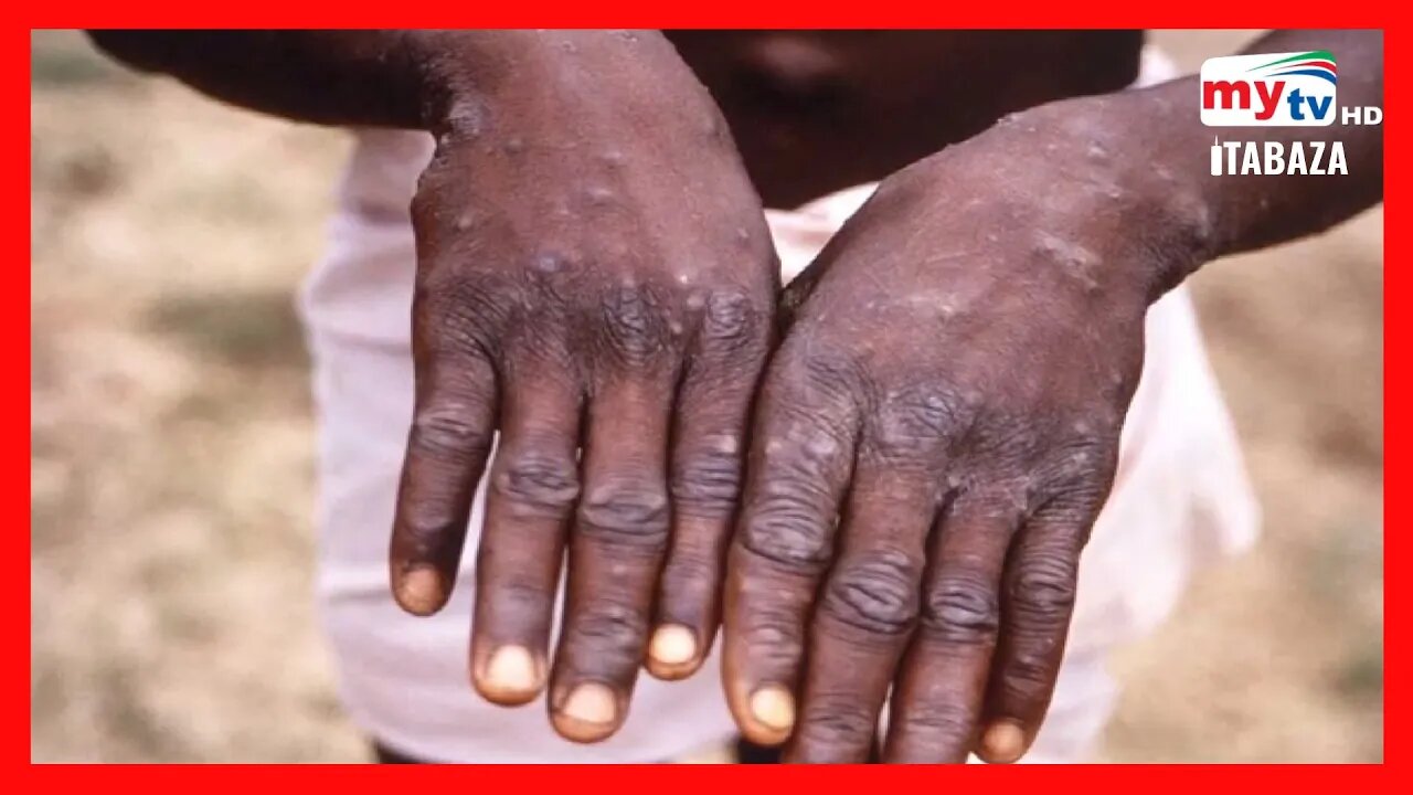 Monkeypox yaba ari ibindi byago Isi yimukiyemo nyuma ya COVID 19?