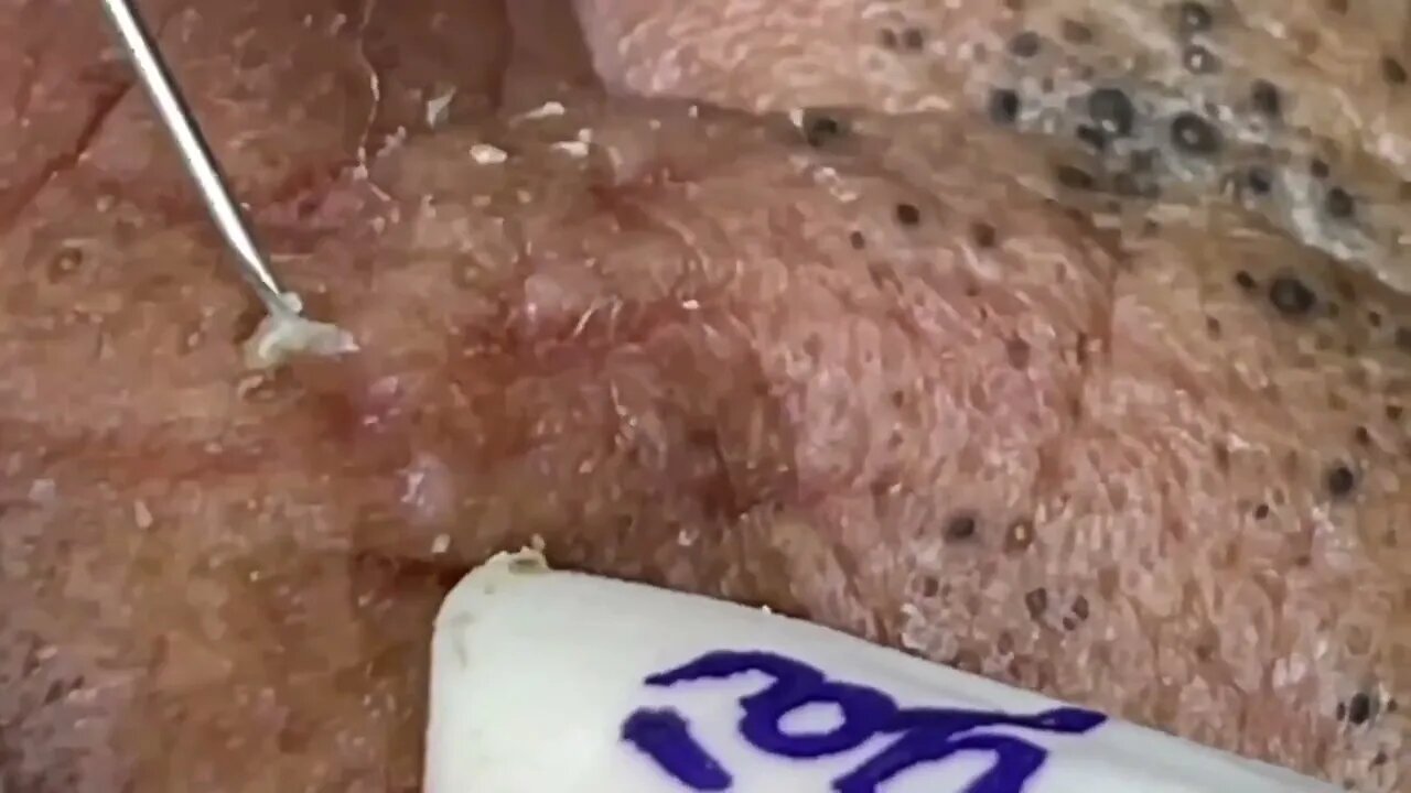 Extraction/removal of huge blackheads on the face! Acne Cravo