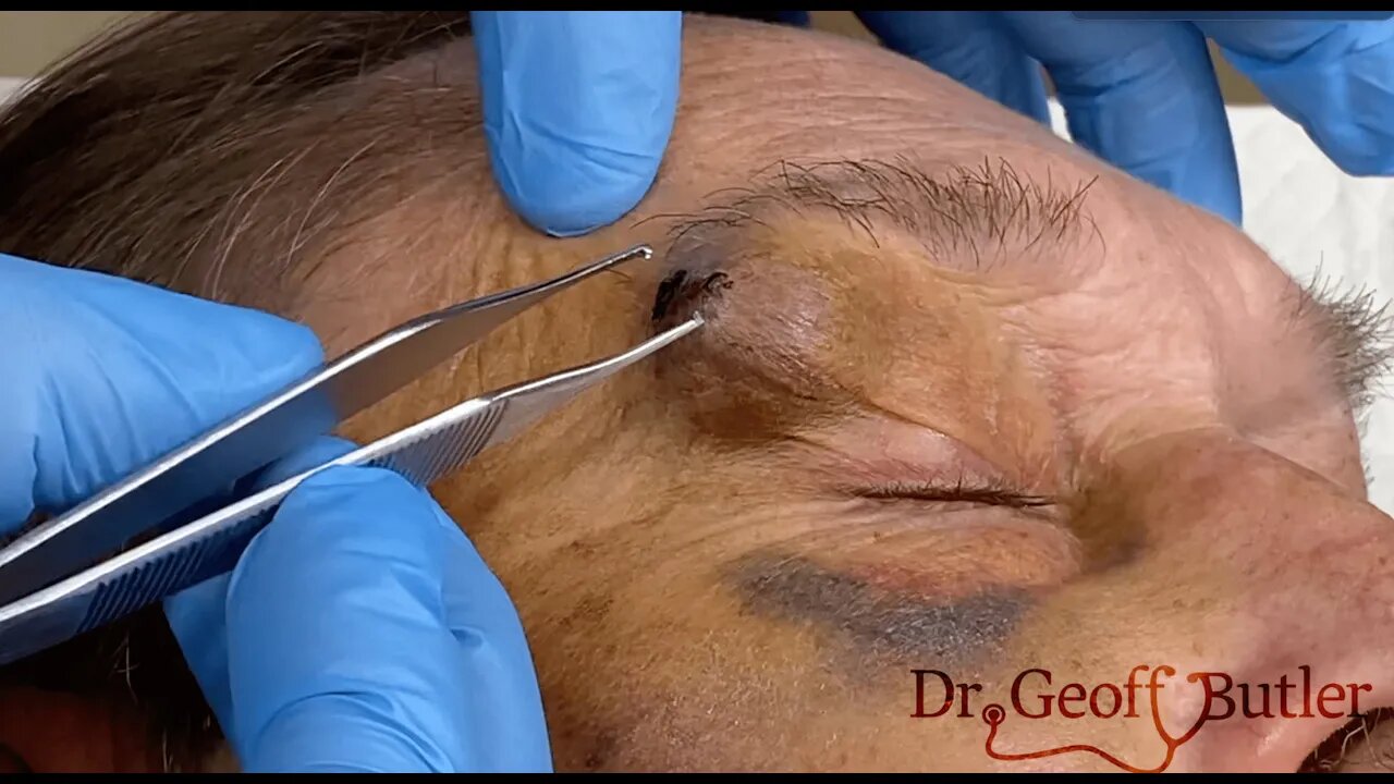 Draining a facial hematoma