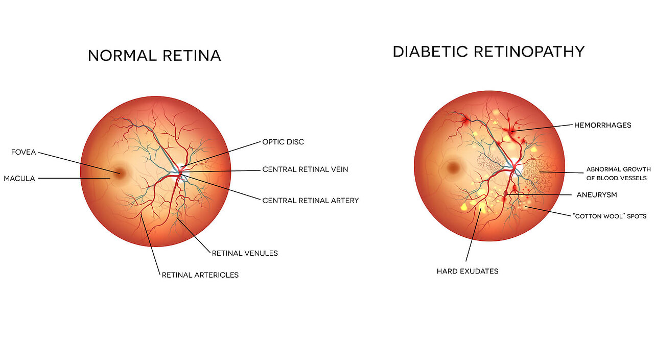 Can diabetes affect your eye health?