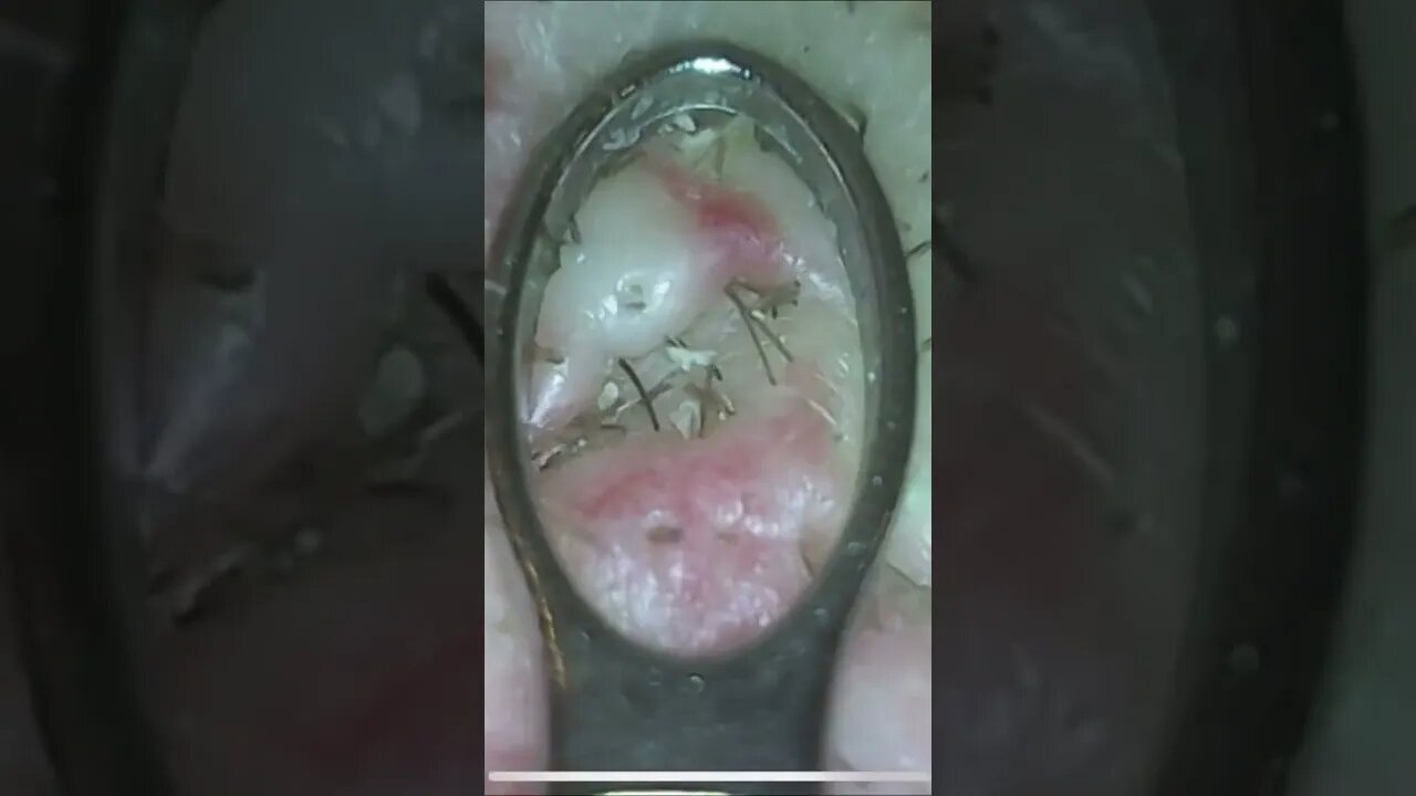 Blackheads, ingrown hair & sebaceous filaments on scalp. OC | Oddly Satisfying Videos