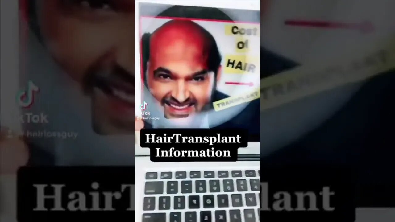 Hair Transplant TikToks I Found Today April 29th, 2022