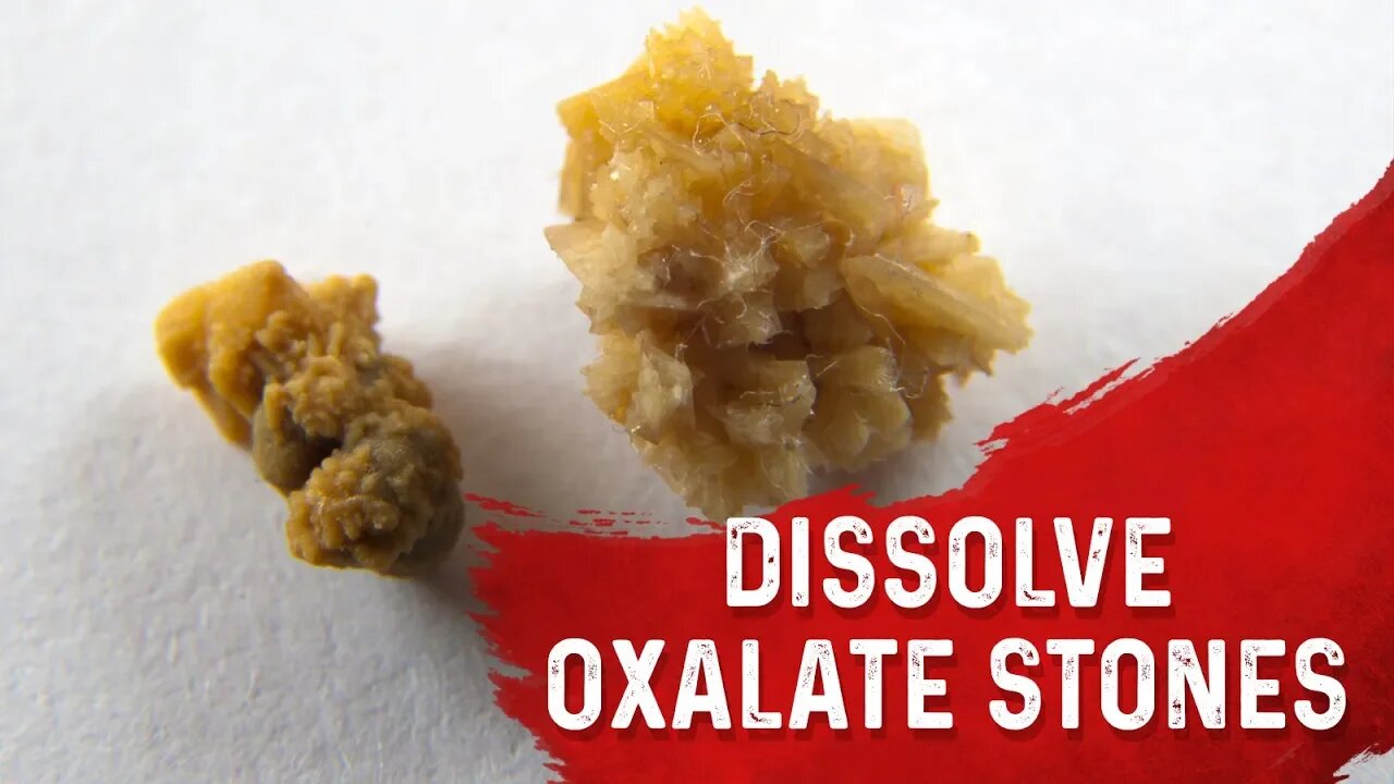 Why You Get Kidney Stones (Oxalate Type) – Removing Kidney Stones & High Oxalate Foods – Dr.Berg