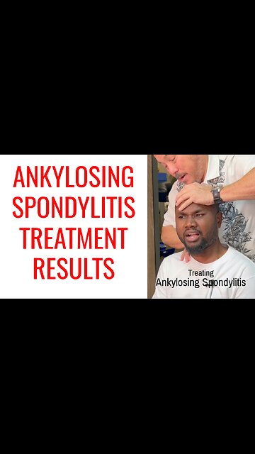 Ankylosing Spondylitis Treatment Results w/ Chiropractor
