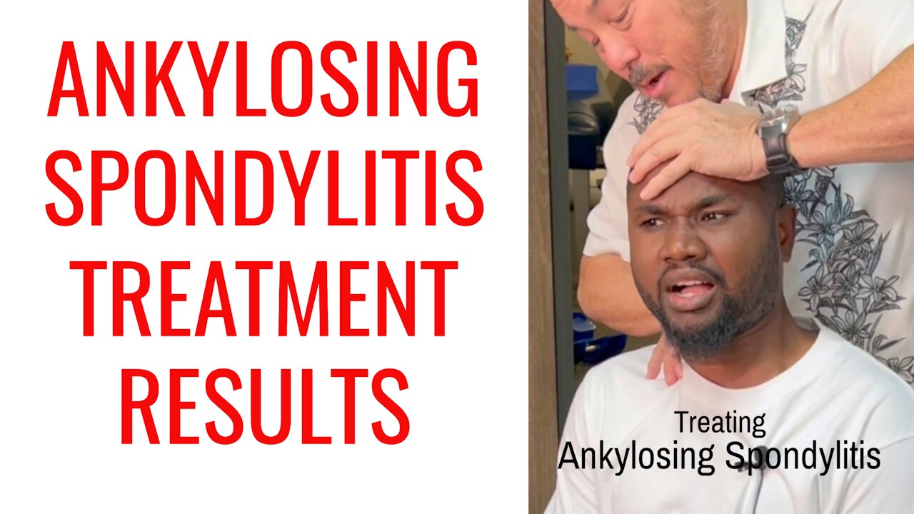 Ankylosing Spondylitis Treatment Results w/ Chiropractor
