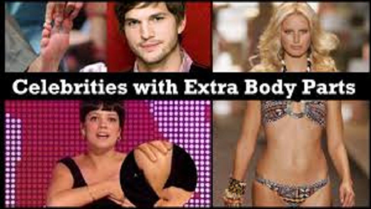 5 People With Extra Body Parts