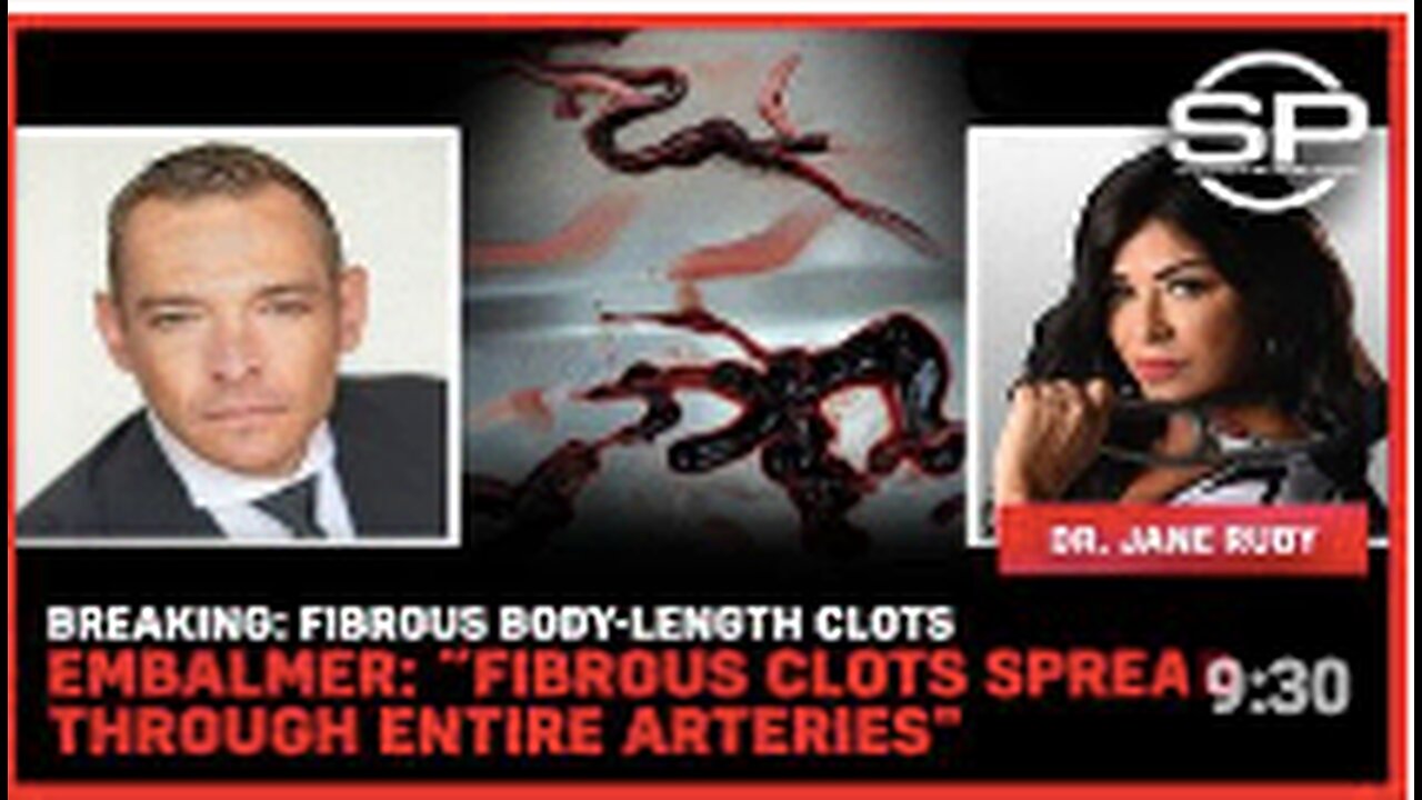 BREAKING: Fibrous Body-Length Clots Embalmer: "Fibrous Clots Spread Through Entire Arteries"