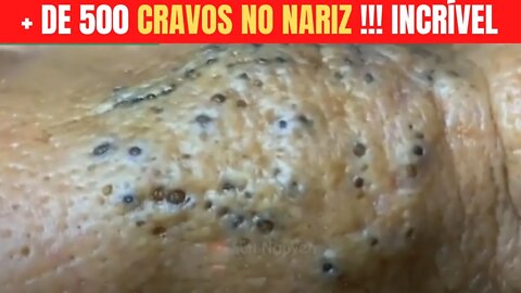 ESPREMENDO CRAVOS E ESPINHAS NO NARIZ Removendo Cravos e Espinhas Satisfatório PIMPLE EXTRACTION