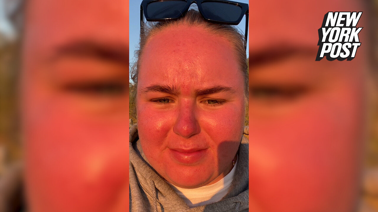 Woman's face 'doubles in size' after spending an hour in the sun