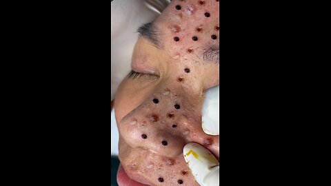 blackhead