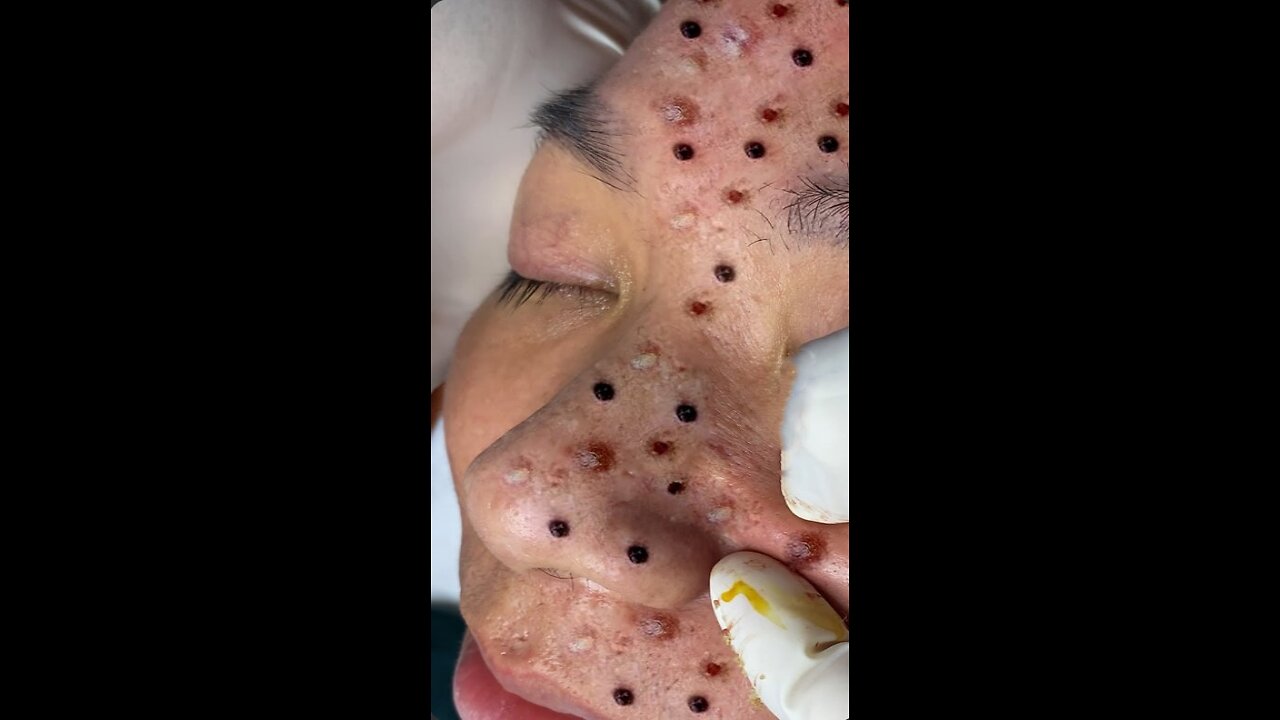 blackhead