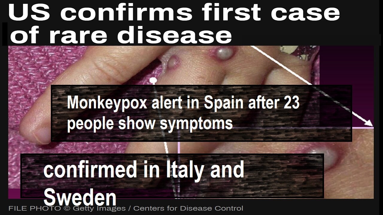 More Monkeypox Outbreaks-Updates