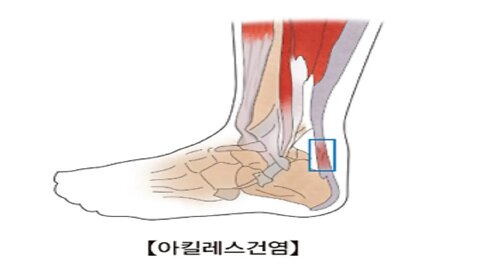 아킬레우스 영웅의 약점 아킬레스건 과 다리 허벅지 종아리 약점 튼살침 치료 St침