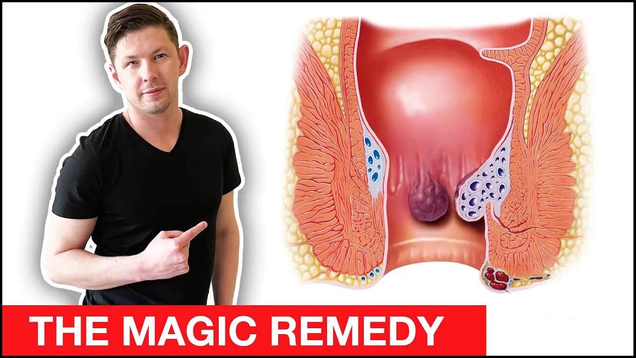 YOU CANNOT HEAL HEMORRHOIDS if you don't do this 1 REMEDY