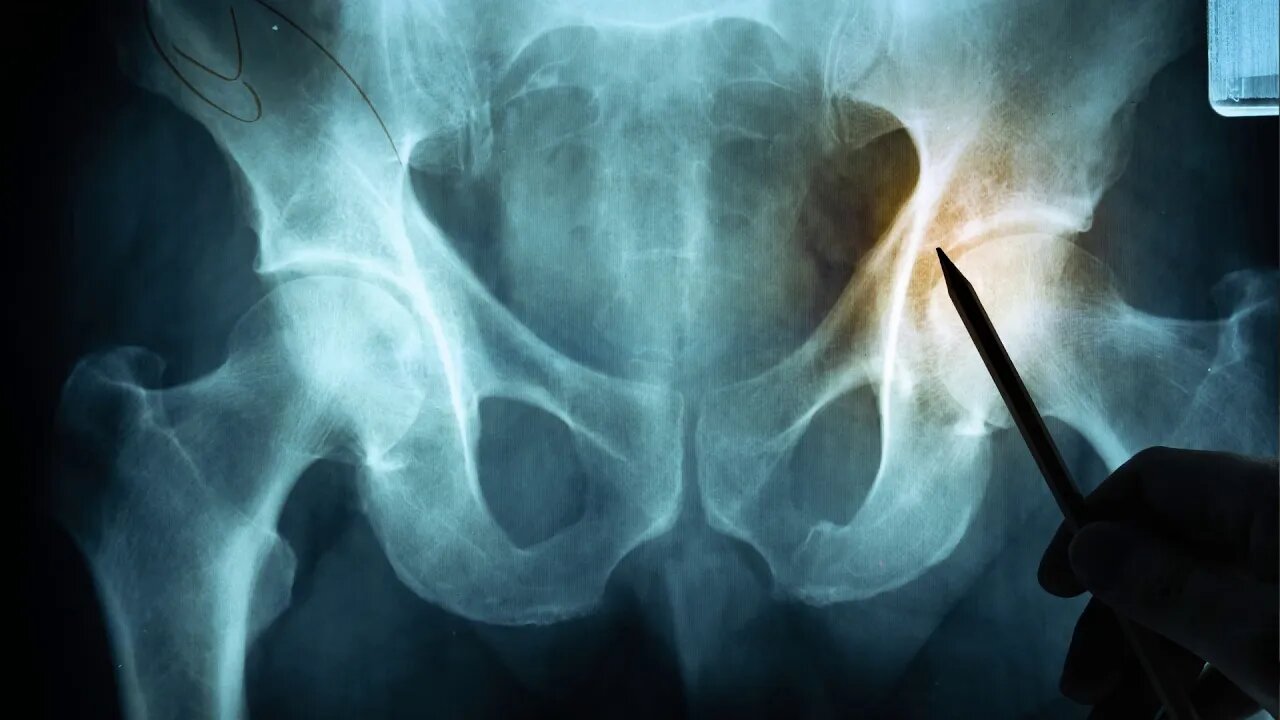 03 A Bone Disease