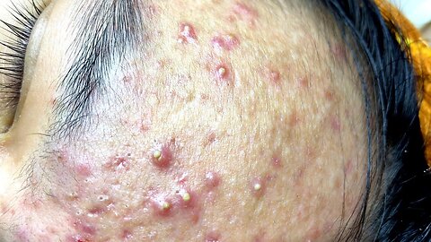 Big Cystic Acne Blackheads Extraction Blackheads & Milia, Whiteheads Removal Pimple Popping 10