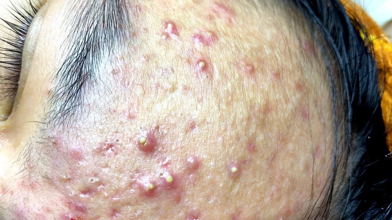 Big Cystic Acne Blackheads Extraction Blackheads & Milia, Whiteheads Removal Pimple Popping 10
