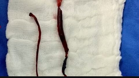 7 fold increase in death since the rollout of the Clot Shots