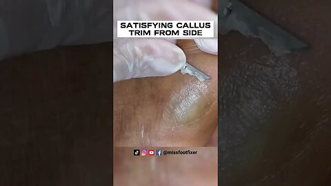 SATISFYING CALLUS TRIM FROM SIDE OF FEET 2022 BY FOOT SPECIALIST MISS FOOT FIXER