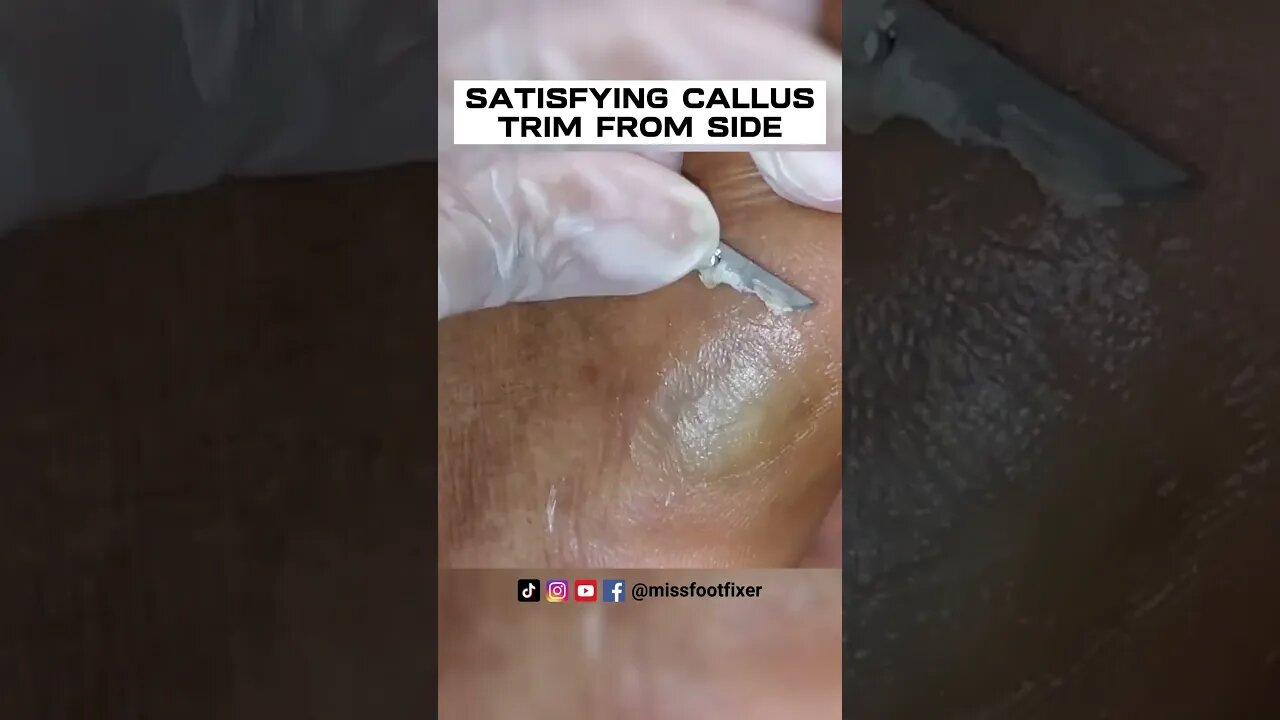SATISFYING CALLUS TRIM FROM SIDE OF FEET 2022 BY FOOT SPECIALIST MISS FOOT FIXER