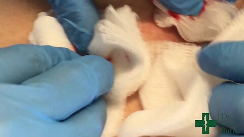 Drainage of an Abscess along the lower back
