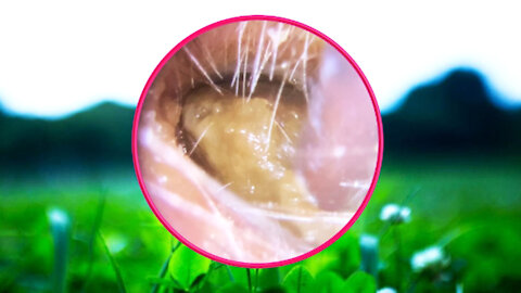 Ear Wax Removal With Clam Relaxing Music #30
