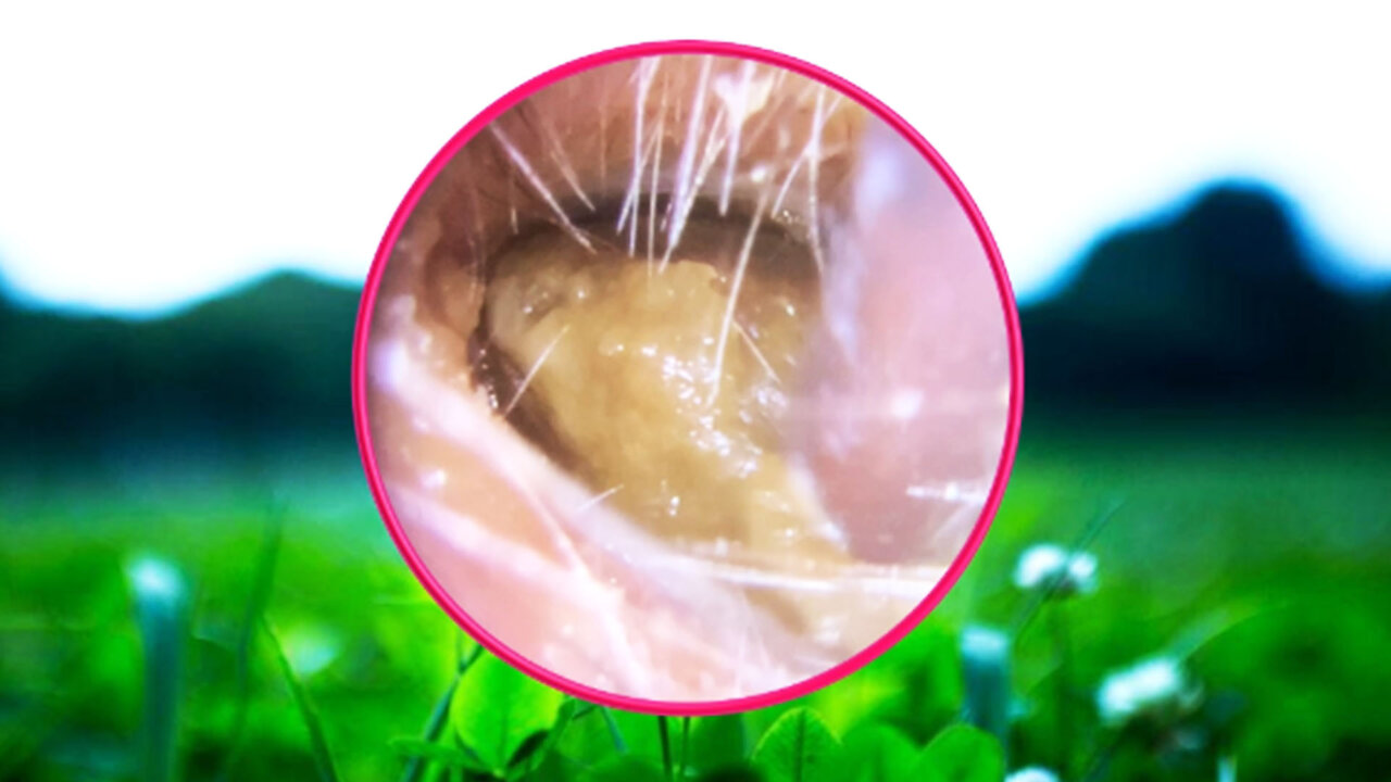 Ear Wax Removal With Clam Relaxing Music #30