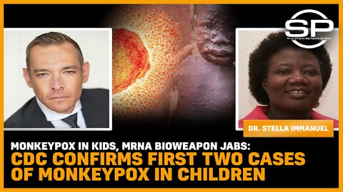Monkeypox In Kids, mRNA Bioweapon Jabs: CDC Confirms First Two Cases Of Monkeypox In Children