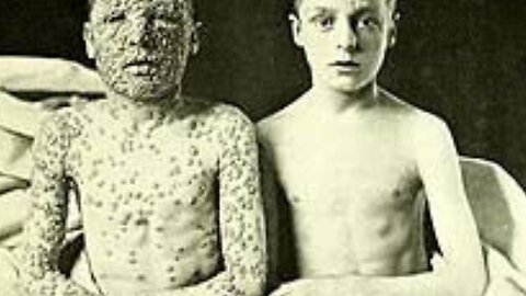 091224 Seg 7 Small Pox Lie Corrected; What You Should Have On Hand If They Bio Weapon Small Pox